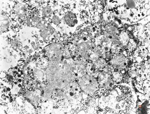 F,69y. | urinary bladder - malakoplakia F,69y. | urinary bladder - malakoplakia